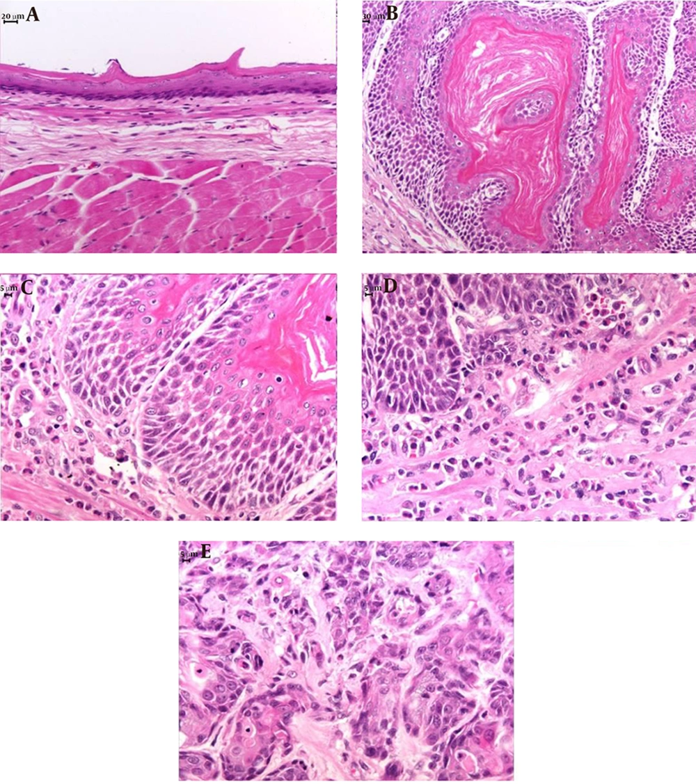 Histological Sections of Esophageal Tissues Stained With HE A, Normal esophageal tissue; B, Hyperplasic epithelium with hyperkeratosis; C, Spongiosis; D, esophagitis; E, Squamous cell carcinoma. Magnification × 400.