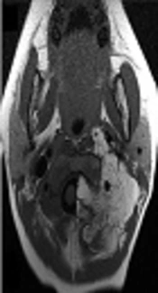 Vertebral Canal Invasion of Cervical Lipoblastoma in Childhood: A Case Report