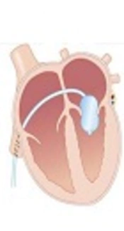 Balloon Valvuloplasty for Pulmonary Stenosis in Children: Immediate Outcome and Cardiac Remodeling during Midterm Follow-up