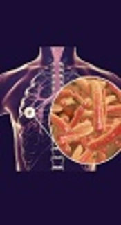 https://www.google.com/url?sa=i&source=imgres&cd=&cad=rja&uact=8&ved=2ahUKEwjiycSK3OLeAhXP2KQKHVMnCRUQjB16BAgBEAQ&url=http%3A%2F%2Fwww.sciencebriefss.com%2Fhealth%2Fto-fight-or-to-tolerate-that-is-the-question-for-tuberculosis&psig=AOvVaw0EeS1nO_-gWOCvKoRCAWz-&ust=1542794651157777