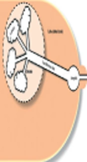 Idiopathic Granulomatous Lobular Mastitis, Semantic Scholar