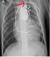 Arch Pediatr Infect Dis