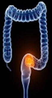 BMI1 as a Potential Target of miR-330-3p in Colorectal Cancer