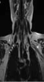 Subclavius Posticus Muscle