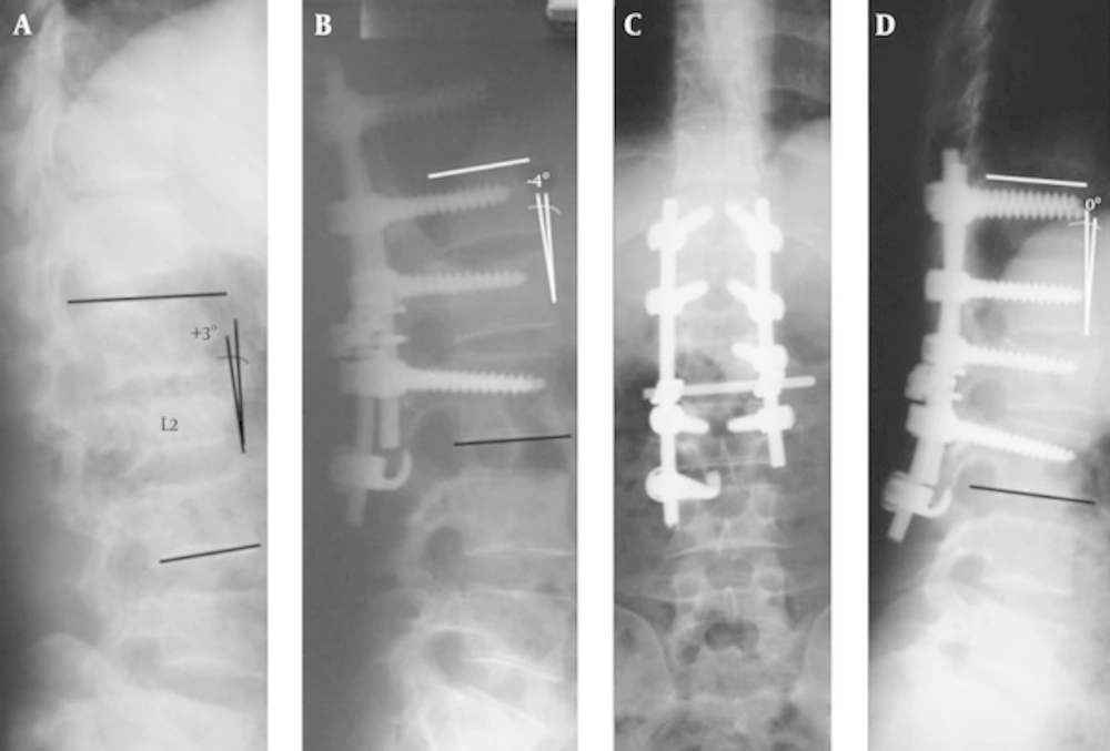 A, a 29 years old woman with L2 burst fracture, on Primary radiography; B, significant vertebral body collapse was observed due to three columns failure, significant height restoration was achieved on immediate postoperative view; C and D, remained relatively constant throughout the follow-up period of 41 months A, a 29 years old woman with L2 burst fracture, on Primary radiography; B, significant vertebral body collapse was observed due to three columns failure, significant height restoration was achieved on immediate postoperative view; C and D, remained relatively constant throughout the follow-up period of 41 months