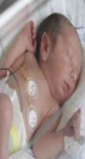 Is Prophylactic Parenteral Paracetamol Effective to Diminish Incidence of PDA in Preterm Neonates? A Randomized Trial