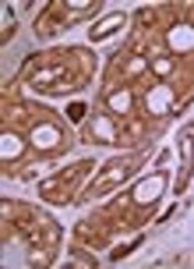 Prognostic Value of P63, Maspin, and MMP-2 Expression in Salivary Gland Adenoid Cystic Carcinoma