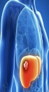 Hepatocelular Carcinoma, Medical Herald