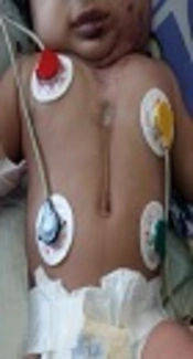 A Three Month-Old Girl with Cleft (Bifid) Sternum and Hemangioma of the Face