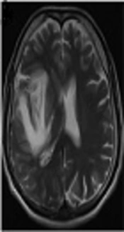 Stroke Status Developed After Herpes Viridae Infection: A Report of Two Cases