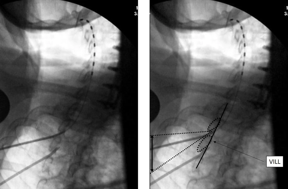 The upper end of the lead lies at C2, and the black double arrow represents how much the needle trajectory may be adjusted when using this view. VILL: ventral interlaminar line. The upper end of the lead lies at C2, and the black double arrow represents how much the needle trajectory may be adjusted when using this view. VILL: ventral interlaminar line.