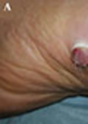 Multifocal Pyogenic Granuloma-Like Kaposi Sarcoma