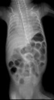 The Effect of Probiotics in Prevention of Necrotising Enterocolitis in Preterm Neonates in Comparison with Control Group