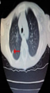 Mutation of the CD40L Gene in X-Linked Hyper-IgM Syndrome: Two Case Reports in Sibling Chinese Patients and a Literature Review