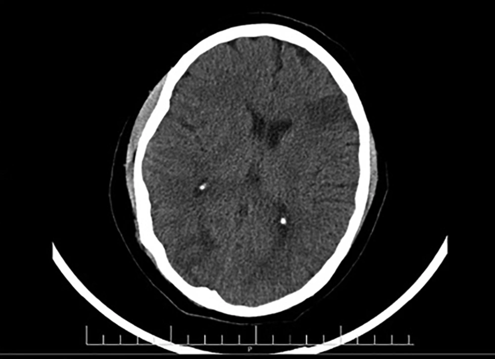 Spiral brain computerized tomography (without contrast); evidence of vasogenic edema was observed at both occipital lobes and right temporal lobe with a 40 × 38 mm hypodense lesion Spiral brain computerized tomography (without contrast); evidence of vasogenic edema was observed at both occipital lobes and right temporal lobe with a 40 × 38 mm hypodense lesion