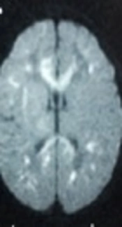 Clinical Characteristics, Diagnosis and Management of Neonatal Stroke