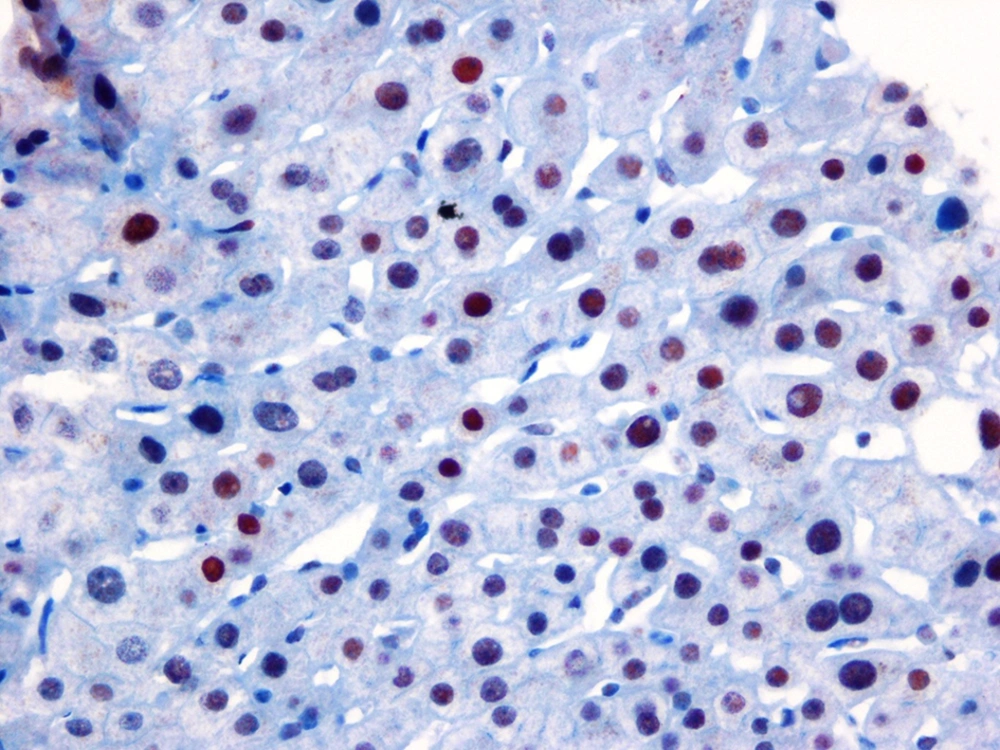 High Expression of Estrogen Receptor α in the Livers of Patients Infected With Hepatitis C Virus Genotype 1b. High Expression of Estrogen Receptor α in the Livers of Patients Infected With Hepatitis C Virus Genotype 1b.