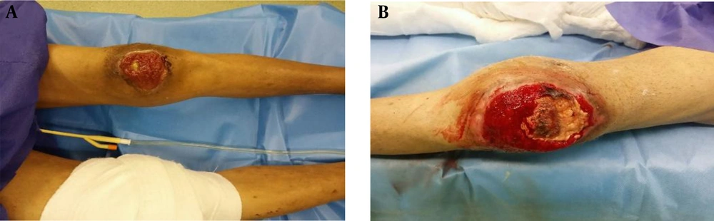 A, Left knee before surgery; B, right knee before surgery. A, Left knee before surgery; B, right knee before surgery.