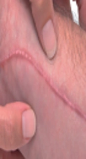Comparing Efficacy and Tolerability of Triamcinolone and Verapamil in Treatment of Hypertrophic Scars and Keloids