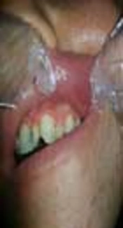 Aphthous Stomatitis
