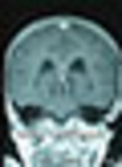 Low Back Pain and Paraplegia as Initial Clinical Presenting of Medulloblastoma: A Case Report