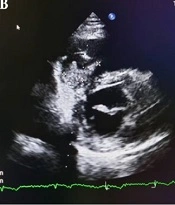 Multidiscip Cardio Annal