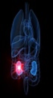 Comparison of Complications and Surgical Outcomes of Percutaneous Nephrolithotomy with and Without Nephrostomy: A Double-Blind Randomized Controlled Trial