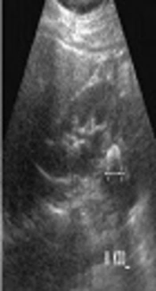 A Case Report on Bartter Syndrome as Urinary Tract Stone and Poor Weight Gain in a One-Year Old Child