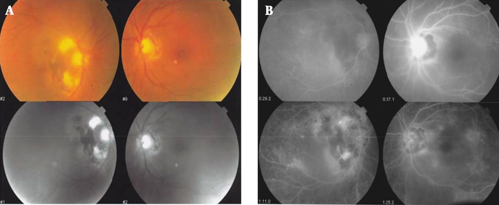 Chorioretinitis Chorioretinitis