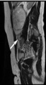 Preoperative Magnetic Resonance Imaging Diagnosis of Ovarian Torsion