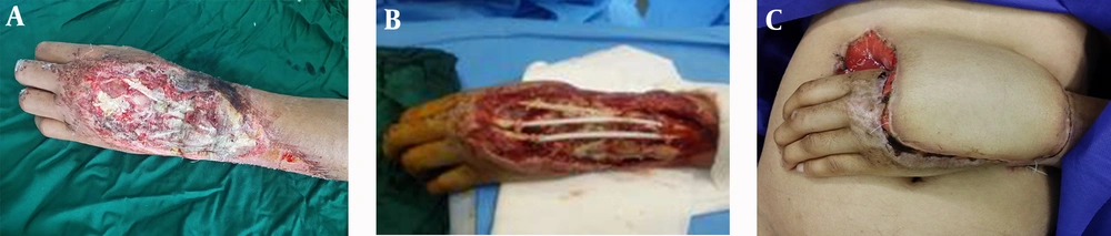 A, Crush Injury; B, Inserting the Silicon Rods; C, Abdominal Flap A, Crush Injury; B, Inserting the Silicon Rods; C, Abdominal Flap