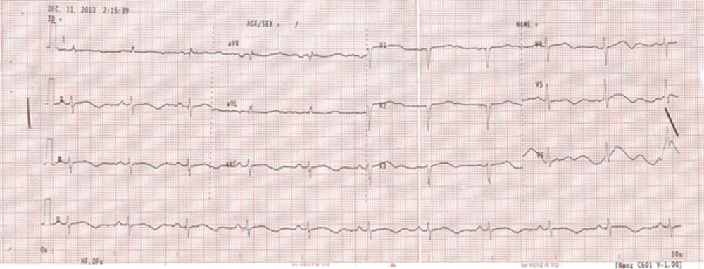 The Electrocardiography (ECG) Data Upon Hospital Admission The Electrocardiography (ECG) Data Upon Hospital Admission