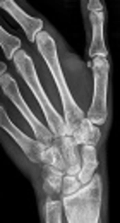 Delayed Union of Scaphoid Fracture and Effectiveness of Pulsed Electromagnetic Fields: A Case Report and Review of the Literature