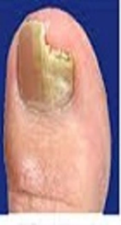 <i>In-Vitro</i> Evaluation of Antifungal Activity of Terbinafine and Terbinafine Nano-Drug Against Clinical Isolates of Dermatophytes