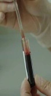 The Prevalence of Hepatitis Delta Virus in Patients with Chronic Hepatitis B and Its Association with Risk Factors