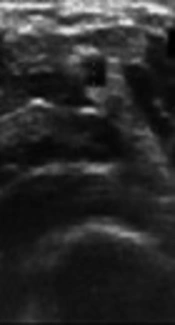 Diameters and Flow Characteristics of Forearm Arteries in the Preoperative Period Using Doppler Ultrasonography in Healthy Individuals