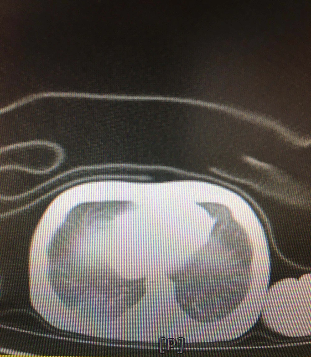 Spiral thorax computed tomography scan without contrast with ground-glass opacities in the right lung suggestive of SARS-CoV-2 pneumonia Spiral thorax computed tomography scan without contrast with ground-glass opacities in the right lung suggestive of SARS-CoV-2 pneumonia