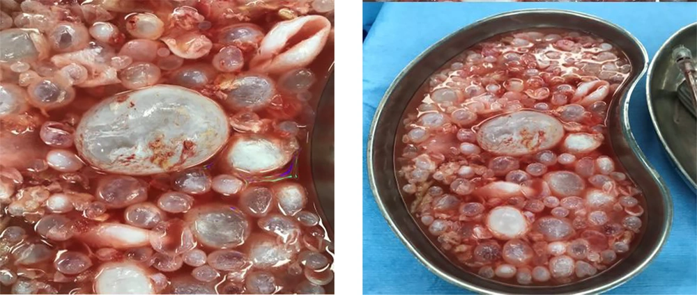 The resected multiple hydatids cystic from intra-myocardium spaces in posterior, inferior, and lateral walls The resected multiple hydatids cystic from intra-myocardium spaces in posterior, inferior, and lateral walls
