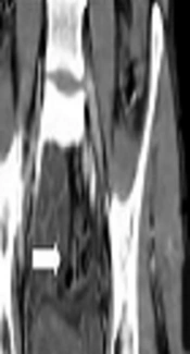 Painless Gross Hematuria: A New Presentation of Primitive Neuroectodermal Tumor of the Prostate