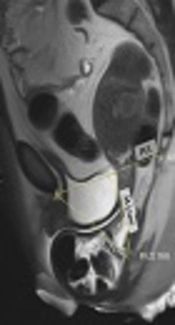 Agreement of Manual Exam (POP-Q) with Pelvic MRI in Assessment of Anterior Pelvic Organ Prolapse