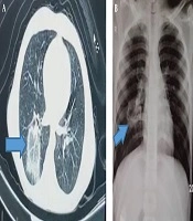 Archives of Pediatric Infectious Diseases