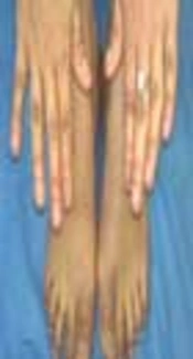 Dystrophic nails