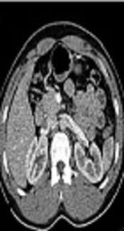 Preoperative Multi-Detector Computed Tomography in Kidney Donors; Quantitative Data Report from Operation Rooms