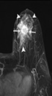 Invasive Carcinoma Arising in Microglandular Adenosis of the Breast: A Case Report and Literature Review