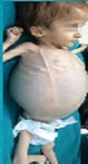 Anesthetic Approach to the Patient with Intraabdominal Pseudocyst After Ventriculoperitoneal Shunt Dysfunction Performed for Hydrocephalus
