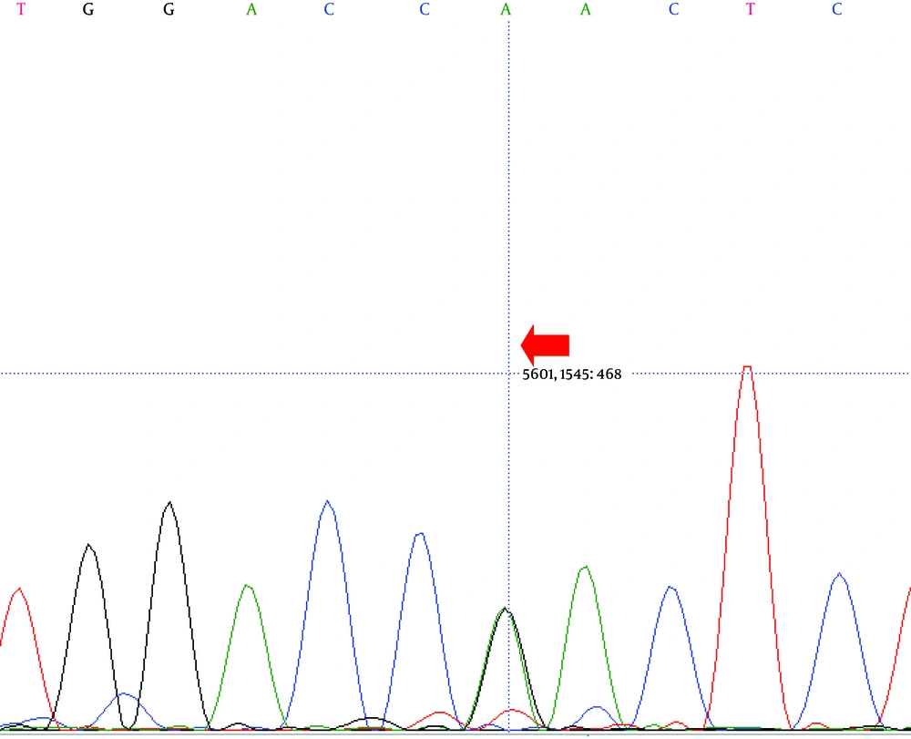 The result of genetic sequencing, indicating the heterozygous missense mutation in exon 10 of the proband’s siblings the LDLR gene (sequencing with forward primer) The result of genetic sequencing, indicating the heterozygous missense mutation in exon 10 of the proband’s siblings the LDLR gene (sequencing with forward primer)