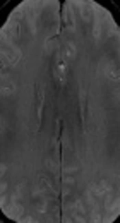 Increased Visibility of Deep Medullary Veins in Transient Ischemic Attack Patients by Using Susceptibility Weighted Imaging