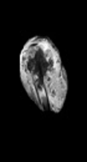 Prediction of Chemotherapy Response in Primary Osteosarcoma by Use of the Multifractal Analysis of Magnetic Resonance Images