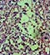 A Case Report of Diffuse Large B-cell Lymphoma Masquerading as Necrotizing Lymph Nodes: The Role of Core Needle Biopsy for Early Diagnosis