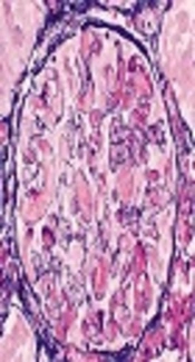 The Prevalence and Incidence of Atypical Hemolytic Uremic Syndrome in Iran: A Systematic Review and Meta-Analysis Protocol Study